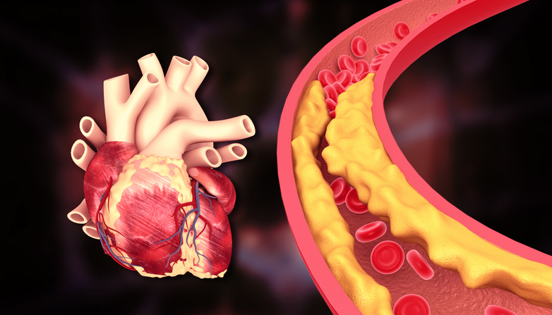 Coronary Sinus Reducer Shows Promise for Coronary Microvascular Dysfunction