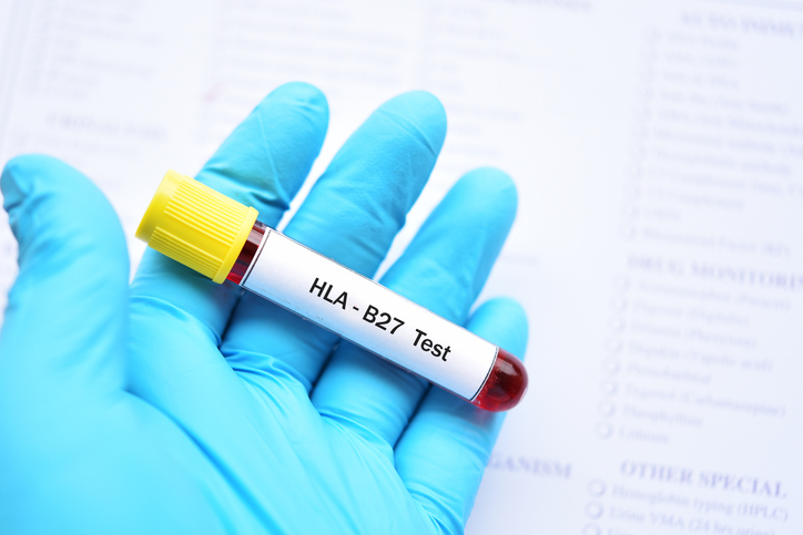 Ordering of HLA-B27 in Clinical Practice