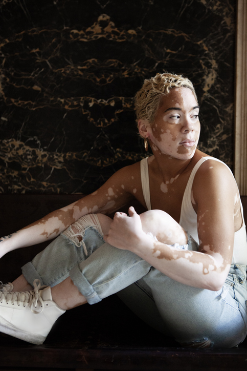 JAK Inhibitors Are a Promising Therapeutic Approach for Treating People With Vitiligo