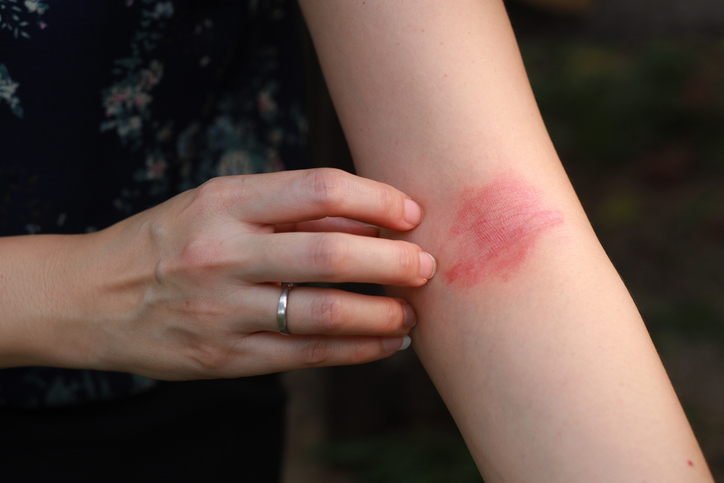 Ucenprubart Shows Promise for Inflammatory Skin Diseases, including Atopic Dermatitis