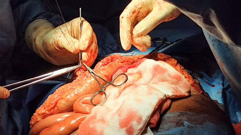 Pancreas-Sparing Duodenectomy for FAP: the Preferred Approach
