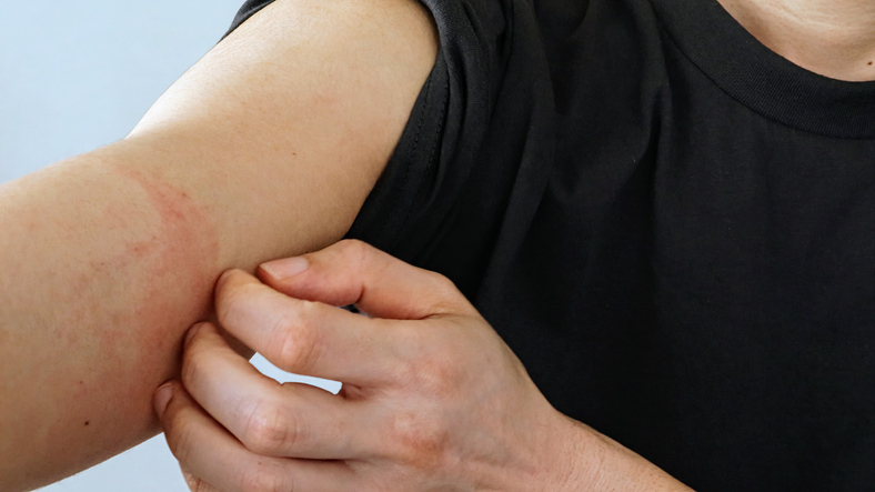 Understanding Eye Problems Linked to Dupilumab Treatment for Eczema