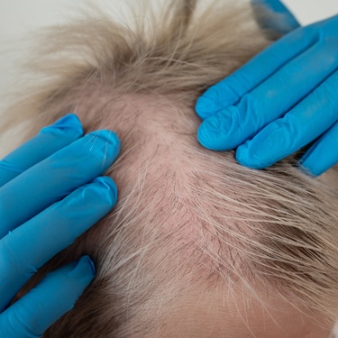 Photo: Docwirenews JAK Inhibitors Show Efficacy in Alopecia Areata Trials