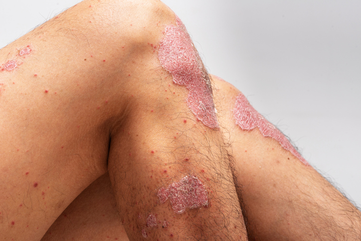 klow peptide for psoriasis Novel Therapy Addresses Systemic Inflammation Beyond Symptom Relief cat wet food Size:Results Pack Does glutathione cause cancer?