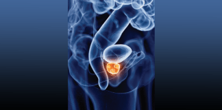 Rectal Spacing Techniques Improve Outcomes in Patients With Prostate Cancer