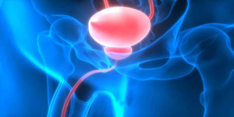 Prognostic Indicators Identified for Bladder Cancer With Isolated Lymph Node Metastasis