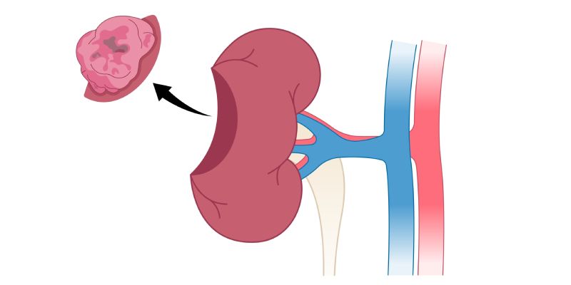 robotic-partial-nephrectomy-outcomes-a-multi-institution-study-gu