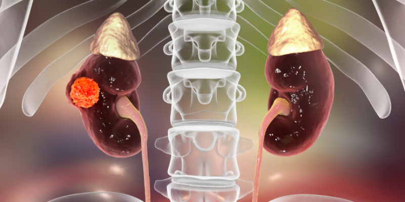 SEER Database Helps Determine OS Outcomes of Renal Medullary Carcinoma