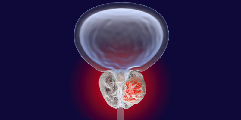 Phenotypic Biomarker Characterization in de Novo Metastatic Prostate Cancer