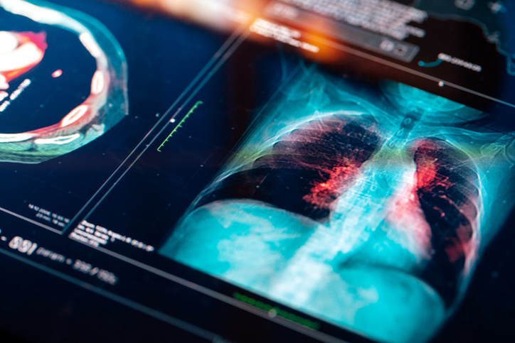 CAMPASS: Benmelstobart Plus Anlotinib Shows Superior PFS in PD-L1 Positive Advanced NSCLC