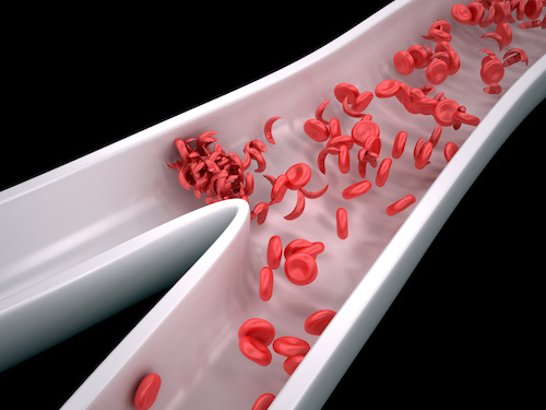 People with Sickle Cell Disease at Increased Risk of Death From Kidney Disease