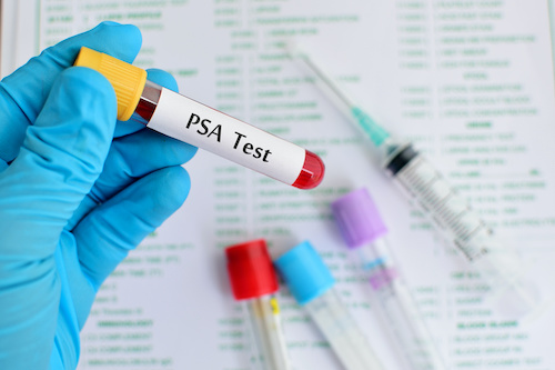 PSA Screening Declines Linked to Higher Rates of Advanced Prostate Cancer