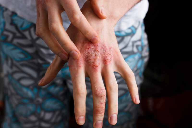 High Rates of Stigma, Bullying Among Children With Chronic Skin Diseases