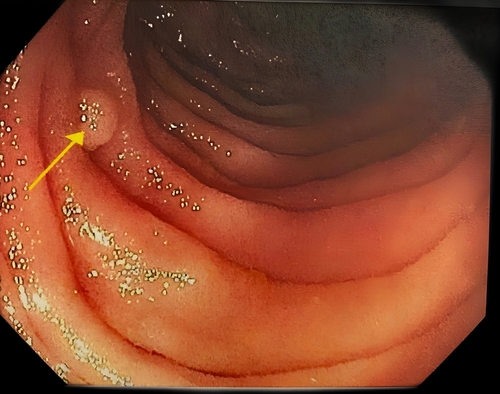 Study Finds Racial Disparities in Colon Polyp Prevalence