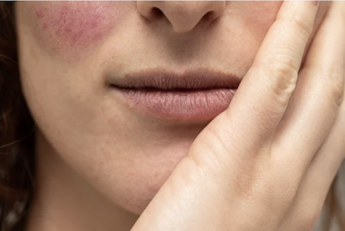 Topical Microencapsulated Benzoyl Peroxide May Balance Skin Microbes of Rosacea