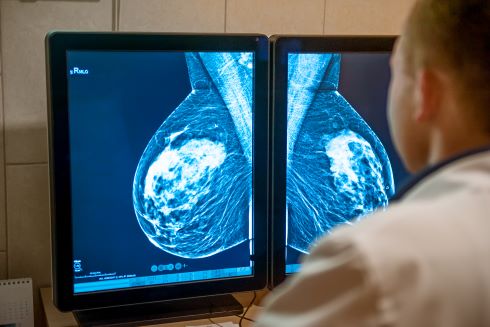 Bilateral Mastectomy Reduces Second Cancer Risk but Not Overall Survival