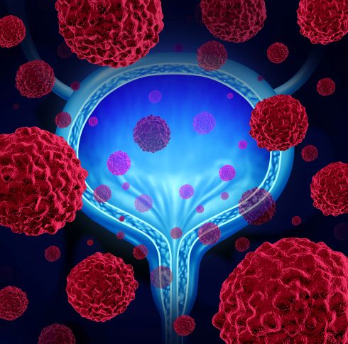 Multiple Sclerosis Patients Show Modest Cancer Risk Increase in Large French Study