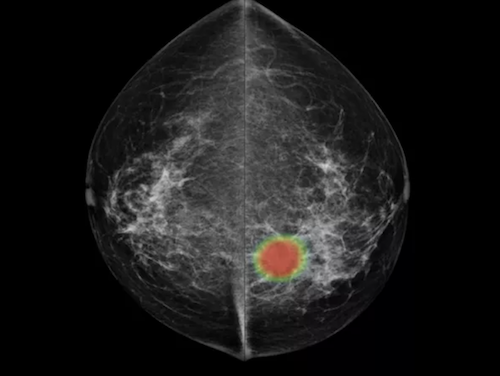 AI Technology Detects One-Third of Missed Breast Cancers in 3D ...